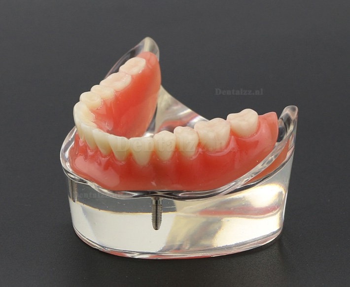 Tandentandenmodel Overdenture Inferieur met 2 implantaten Studiedemo Model 6002 01